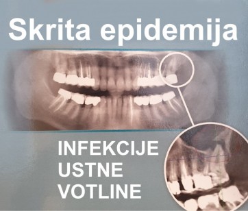 Skrita epidemija - infekcije ustne votline