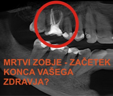 So mrtvi zobje res tako nevarni?
